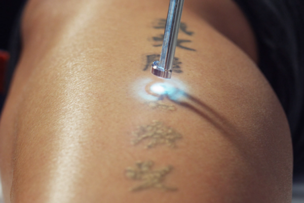 The Truth About Laser Tattoo Removal: Pain, Cost and Results | Nathan  Heightz - YouTube